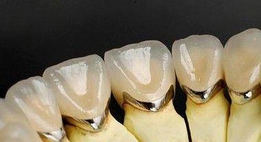 钴铬烤瓷牙齿的优缺点