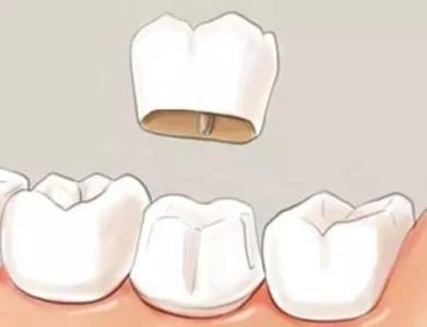 牙齿牙冠是什么