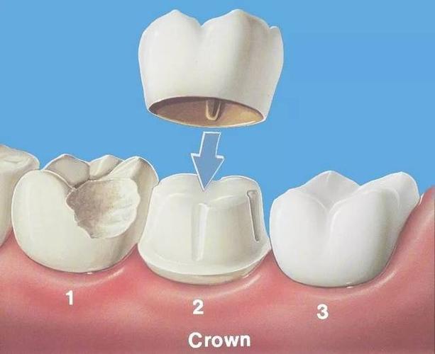牙齿牙冠是什么