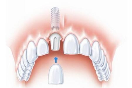 固定义齿磨牙减少牙齿寿命吗