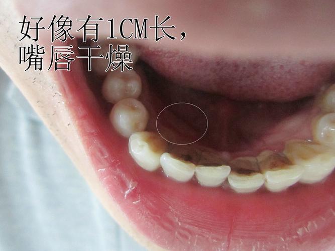 牙齿根部惊人突出揭秘独特牙齿现象，医生大呼不可思议